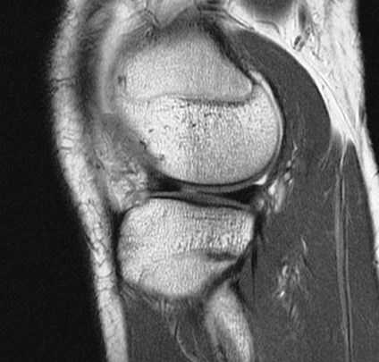 Figure 1 for case Unstable displaced lateral meniscus flap tear( RID2763 )